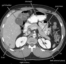 سی تی اسکن شکم , سی تی اسکن قفسه سینه, سی تی اسکن , ct scan, abdominal ct scan